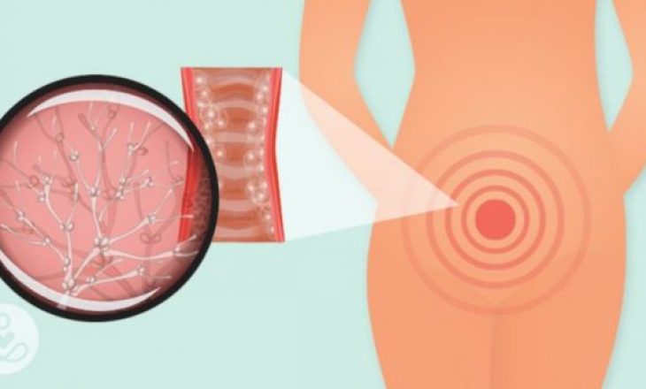 Cilat janë shkaqet e mykut vaginal?