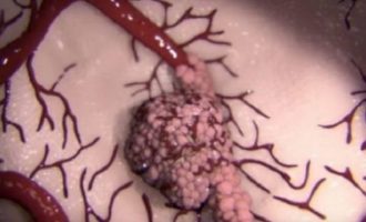 Del videoja e paparë, kështu përhapet kanceri në trup