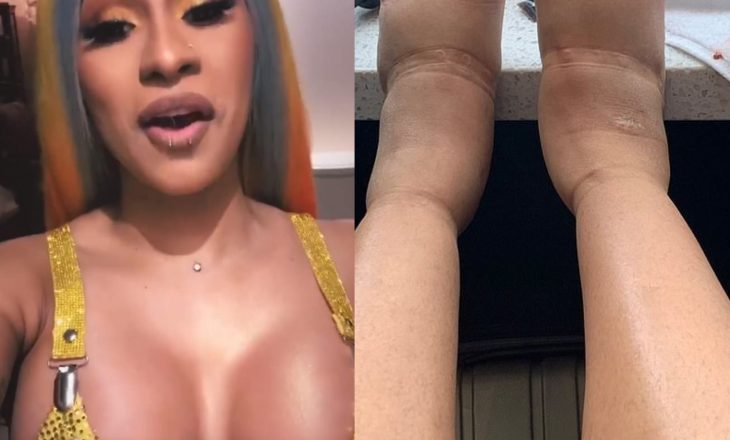 Pas fotos së frikshme me këmbët e fryra, reperja e famshme: S’ka më ndërhyrje estetike
