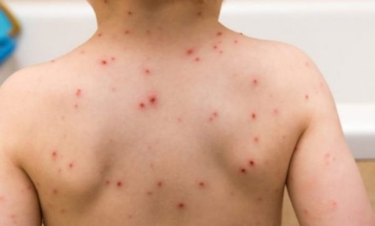 Bie numri i të infektuarve nga sëmundja e fruthit