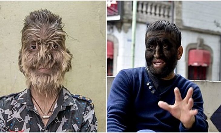 Morën ilaçe të kontaminuara, 16 fëmijë preken nga ‘sindroma ujk’