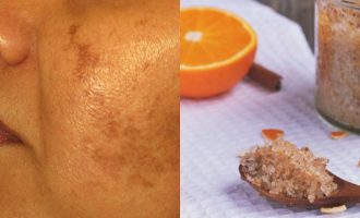 3 metoda natyrale për të zhdukur njollat kafe të diellit