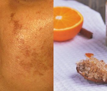 3 metoda natyrale për të zhdukur njollat kafe të diellit