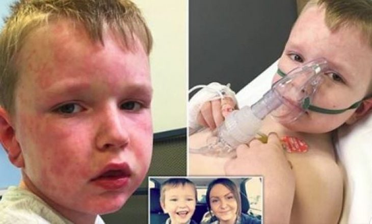 E rrallë: 7-vjeçari që është alergjik ndaj dimrit