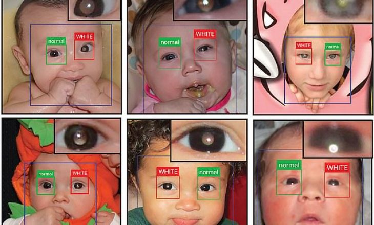 Aplikacioni në telefon që mund të diagnostikojë kancerin e syve