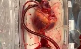 Mjekët sjellin zemrën e vdekur përsëri në jetë