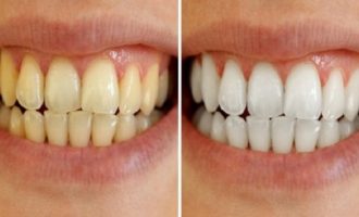 Zgjidhjet natyrale kundër problemeve me dhëmbët