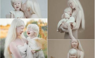 Set i veçantë fotografik, motrat me sindromën e rrallë publikojnë fotot e mrekullueshme