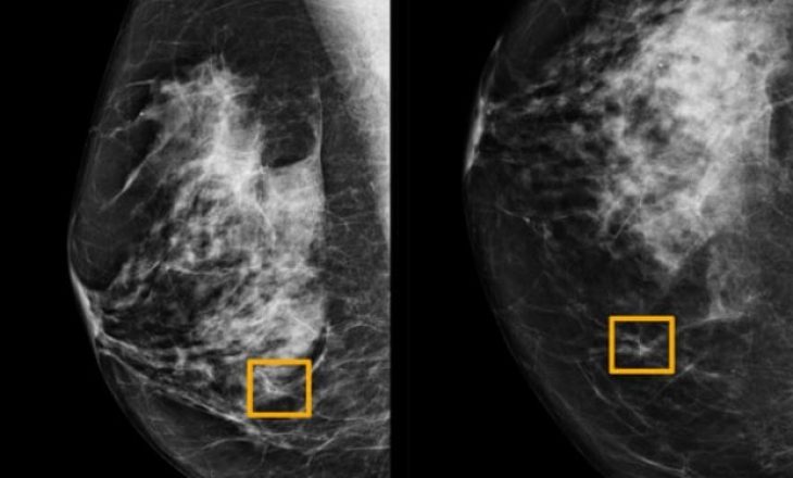 Inteligjenca artificiale kapërcen mjekët në diagnostikimin e kancerit të gjirit