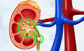 Zbuloni gurët ende pa i dëmtuar veshkat: Këto janë simptomat e sëmundjes