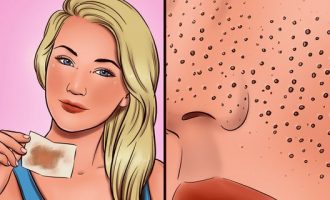 Me këto metoda largoni poret e zgjeruara nga fytyra