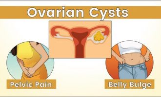 I keni këto simptoma, shkoni menjëherë tek gjinekologu