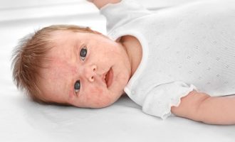 Si mund të identifikoni alergjitë tek fëmija juaj