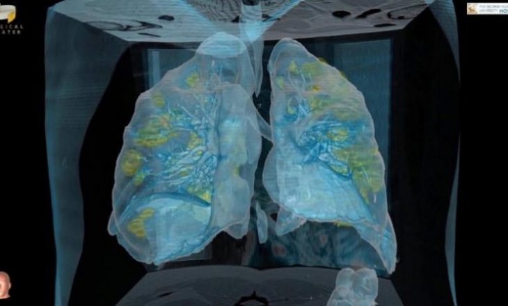 Pamje të rënda: Mushkëritë e pacientit me COVID-19, pse nuk ndihmon respiratori