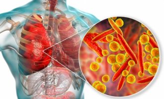 ​Çfarë ndodh me mushkëritë e njerëzve kur marrin koronavirus?