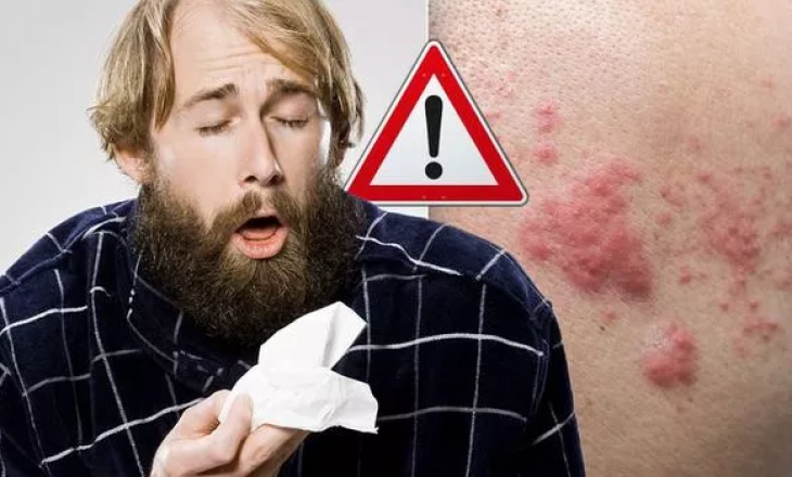 ‘Kujdes nëse keni skuqje’, shkencëtarët zbulojnë simptoma të reja të kronavirusit në lëkurë