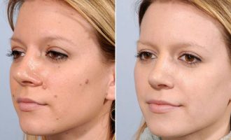 Me këtë përbërës të thjeshtë mund t’i hiqni lythat