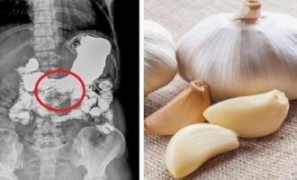 Kujdes! Njerëzit që vuajnë nga kjo sëmundje e kanë të ndaluar nga mjeku të përdorin hudhrën