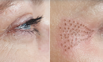 Çfarë është kjo ndërhyrje estetike që po e shihni ngado në rrjete sociale?