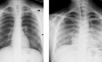 Mjeku kosovar tregon se si dëmtohen mushkëritë nga Coronavirusi