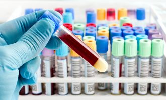 Testet serologjike s’janë për diagnostikim të COVID-19, janë për hulumtime