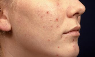 6 mënyra për të parandaluar aknet