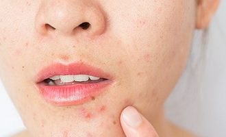 Pse na dalin puçrra në periudha stresuese?