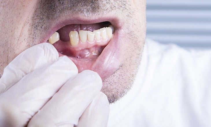 Humbja dhe problemet e dhëmbëve mund të jenë simptomat më të fundit të lidhura me COVID