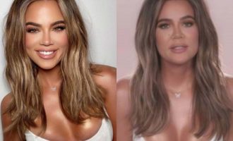 Kirurgët plastikë shpjegojnë se si fytyra e Khloe Kardashian është rezultat i operacioneve