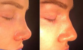 Moderatorja shqiptare pas ndërhyrjes estetike: “Këtë moment e kam pritur qëkur isha 13 vjeç!”