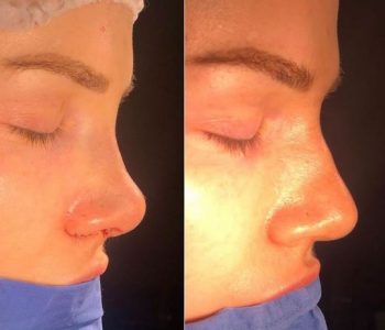 Moderatorja shqiptare pas ndërhyrjes estetike: “Këtë moment e kam pritur qëkur isha 13 vjeç!”