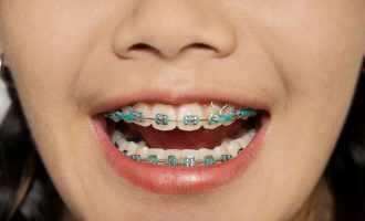 Për çfarë shërbejnë elastikët (shiritat e gomës) për protezat e dhëmbëve?