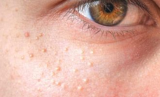 Çka janë ato puçrrat e bardha që shfaqen rreth syve tuaj?