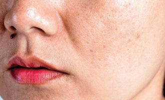 Çka shkakton pigmentimin e lëkurës?