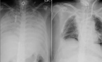 Pacienti japonez COVID-19 i nënshtrohet transplantimit të parë të mushkërive nga dhuruesi i gjallë