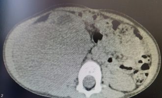 Në QKUK operohet një fëmijë 2 vjeç, i hiqet tumori me përmasa të mëdha